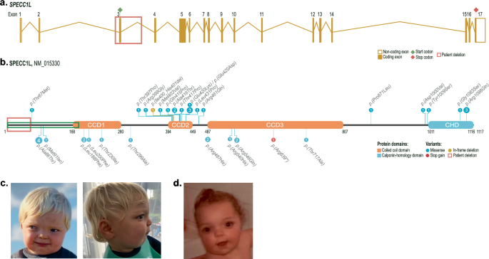 Disruption of SPECC1L translation initiation by intragenic deletion: novel pathogenic mechanism in Teebi-hypertelorism syndrome