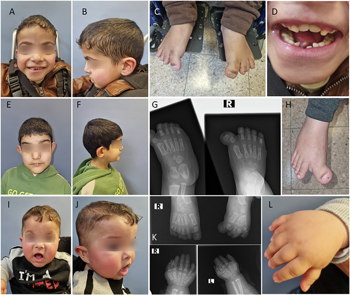 A ciliopathy combining Joubert syndrome and Oro-Facial-Digital syndrome caused by bi-allelic 5’-UTR loss-of-function CEP83 variant