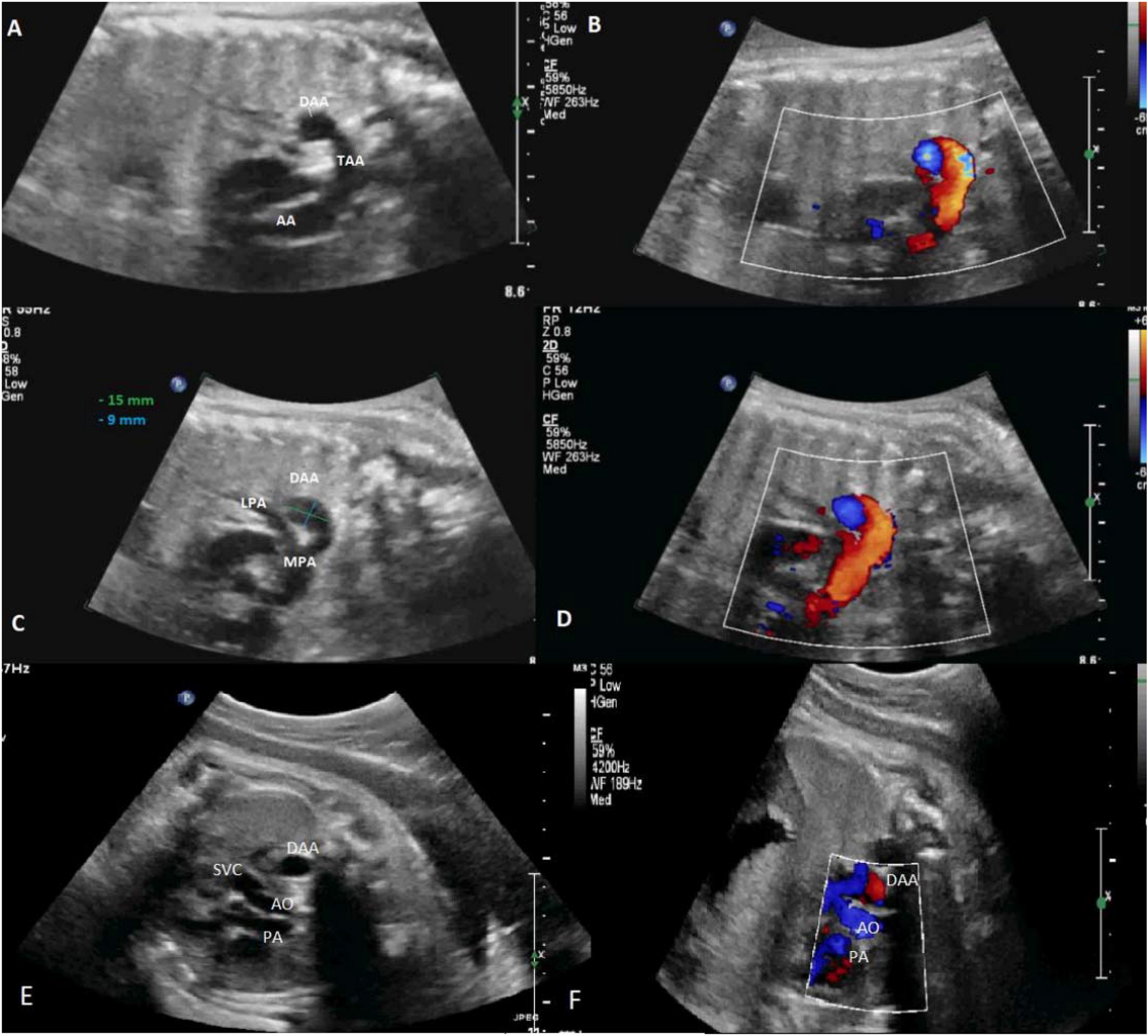 Prenatal Diagnosis of Ductus Arteriosus Aneurysm: A Case Report and Literature Review