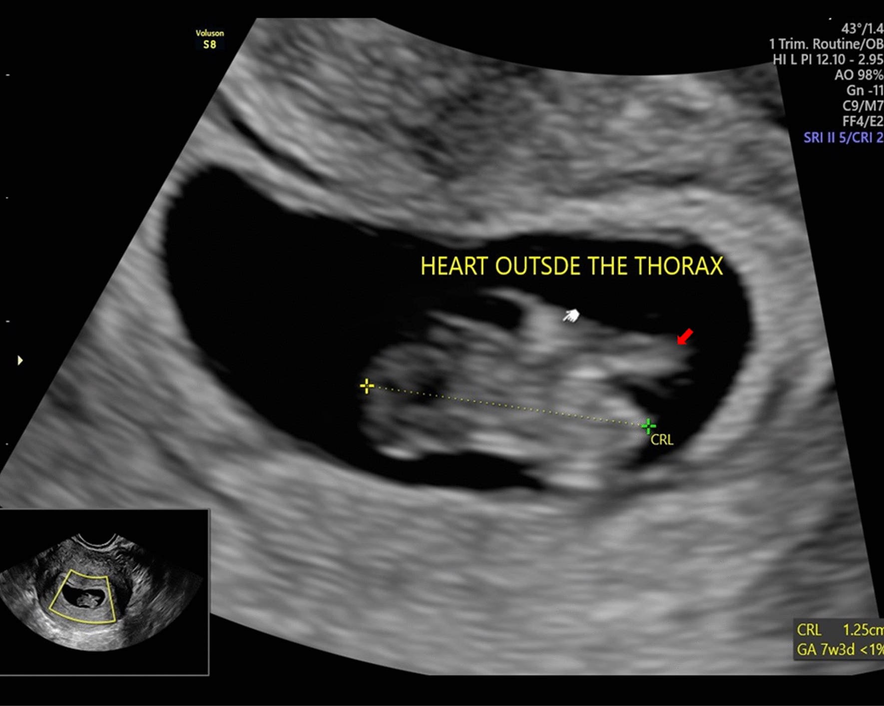 Ectopia Cordis: Case of an Early Diagnosis and Review of Literature