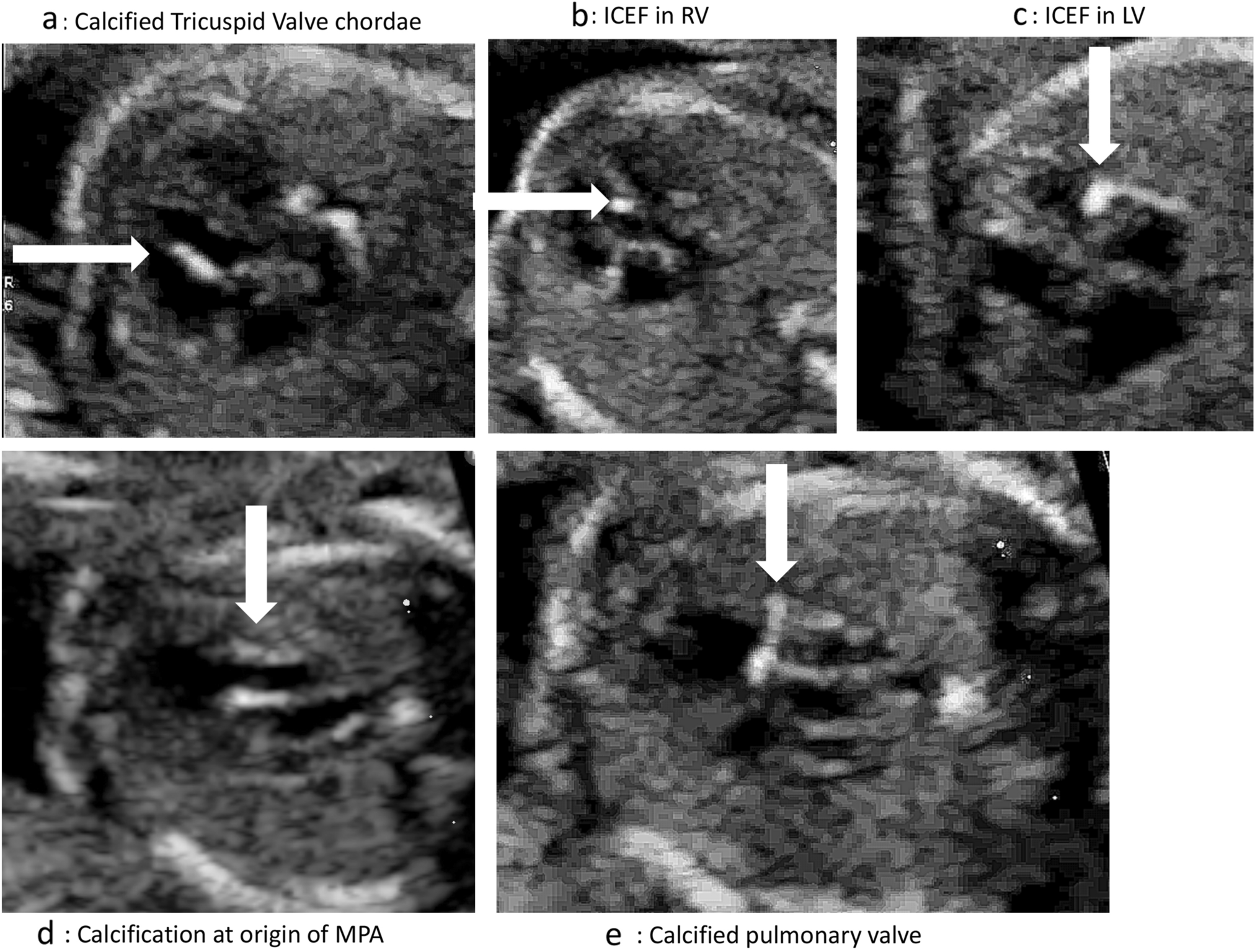 Fetal Endocardial Valvular and Supravalvular Calcification as a Manifestation of Anti-Ro/SSA-La/SSB Antibody Mediated Cardiac Phenotype