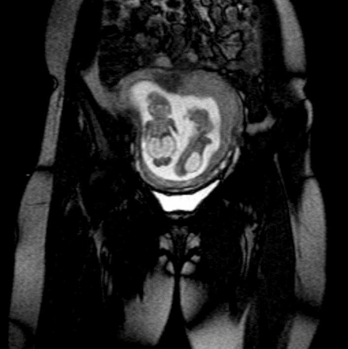 Meckel-Gruber Syndrome in Twin Pregnancy: A Case Report