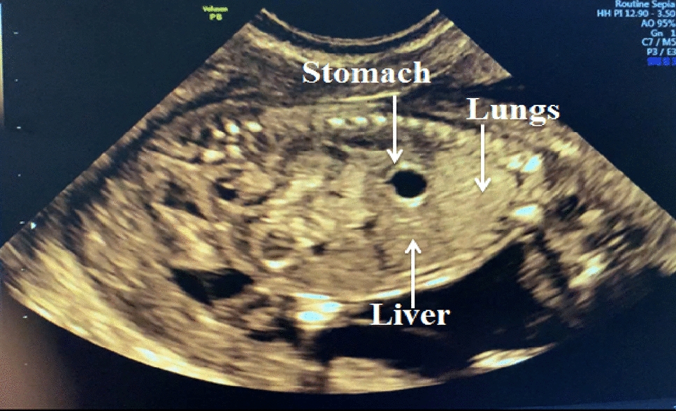 Unilateral Agenesis of Diaphragm with Bilateral Renal Agenesis: An Anomaly Diagnosed Prenatally During a NT Scan (11–14 Weeks)