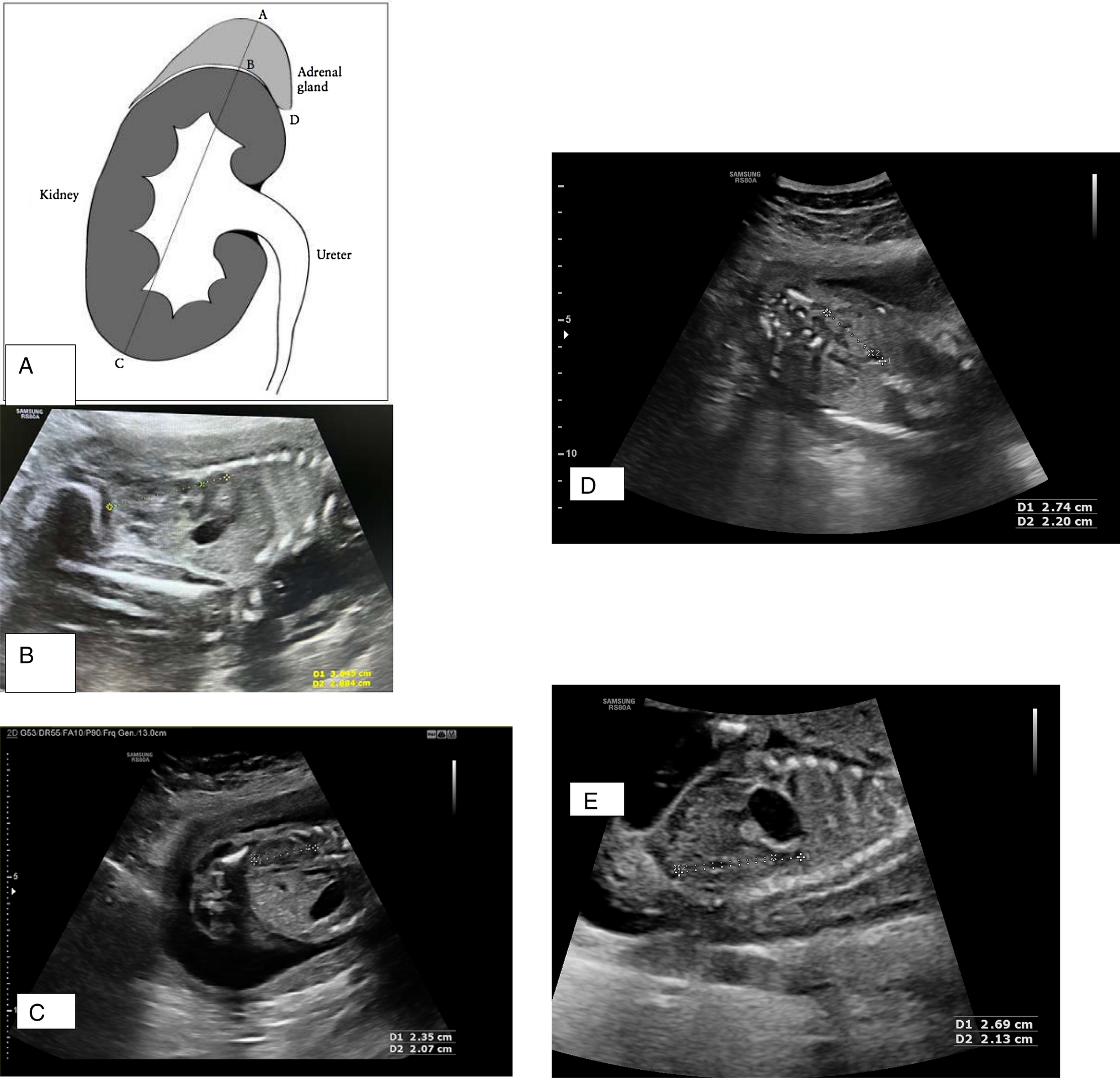 Centile Charts of Fetal Kidney and Adrenal Gland Length: A Prospective Study in Indian Population in the State of Bihar