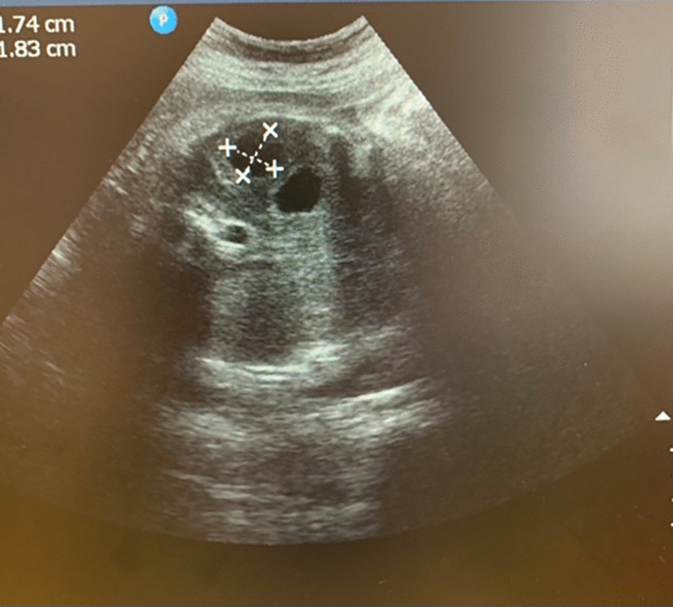 Congenital Splenic Cyst; Video Case Presentation and Literature Review