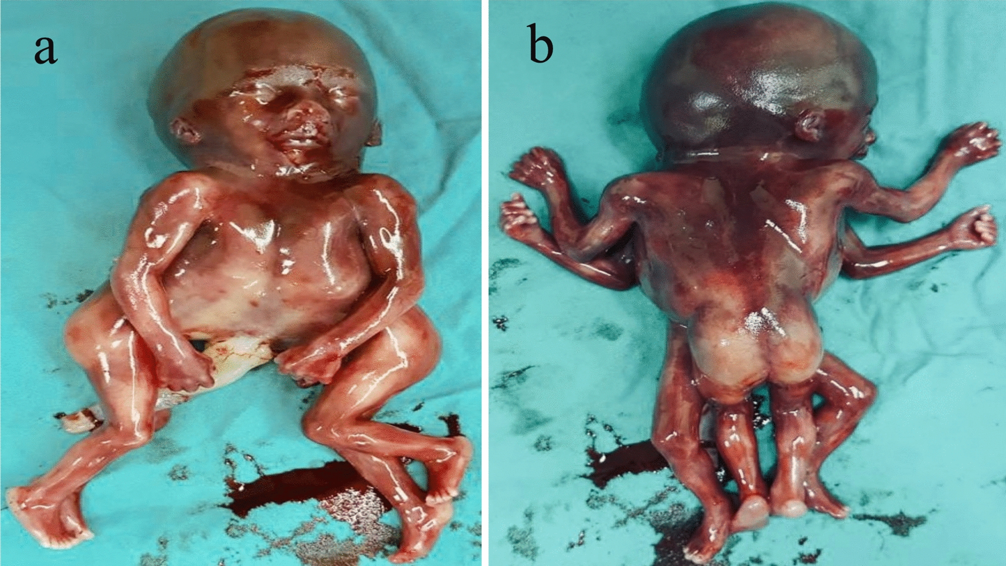 Conjoined Twins: Unicephalus Non-Janiceps Tetrapus Tetrabrachius