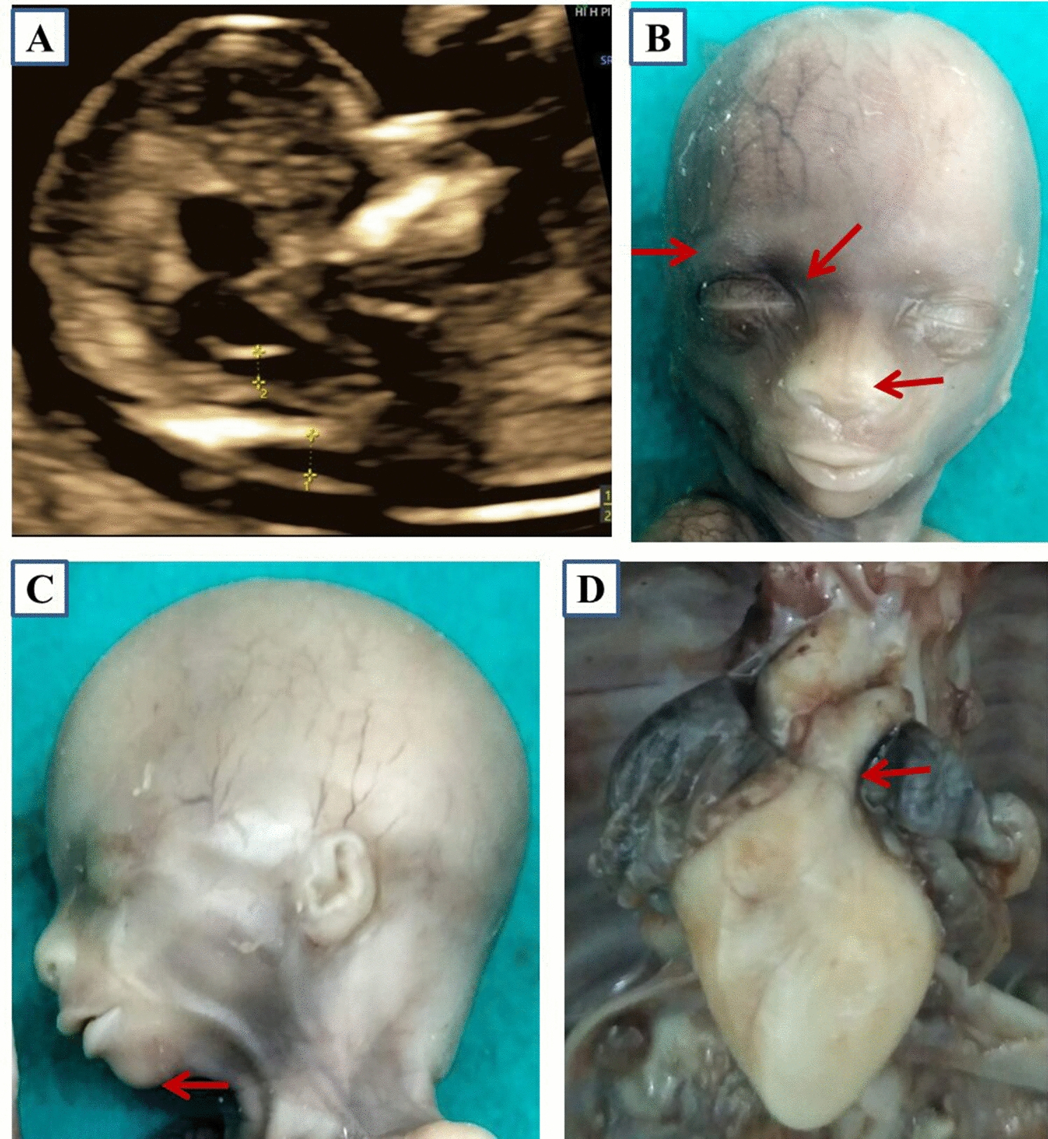 Phenotypic Overlap of 22q11.2 Microduplication and Noonan Syndrome in a Fetus with Increased NT, Facial Dysmorphism, and Narrow Pulmonary Trunk