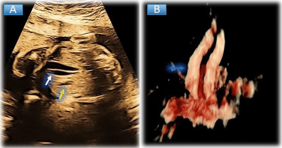 Fetal 3D Imaging and HDlive Silhouette in Unraveling a Rare Case of Gall Bladder Anomaly with Fetal MRI Correlation