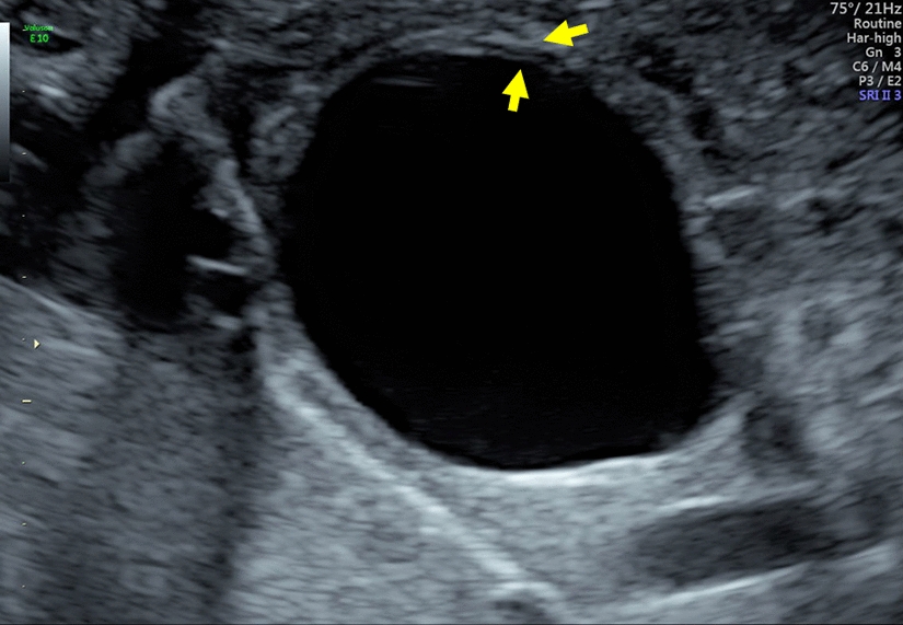 Altering Appearance of Fetal Enteric Duplication Cysts: The Gut Signature Sign and Other Indications for Prenatal Diagnosis