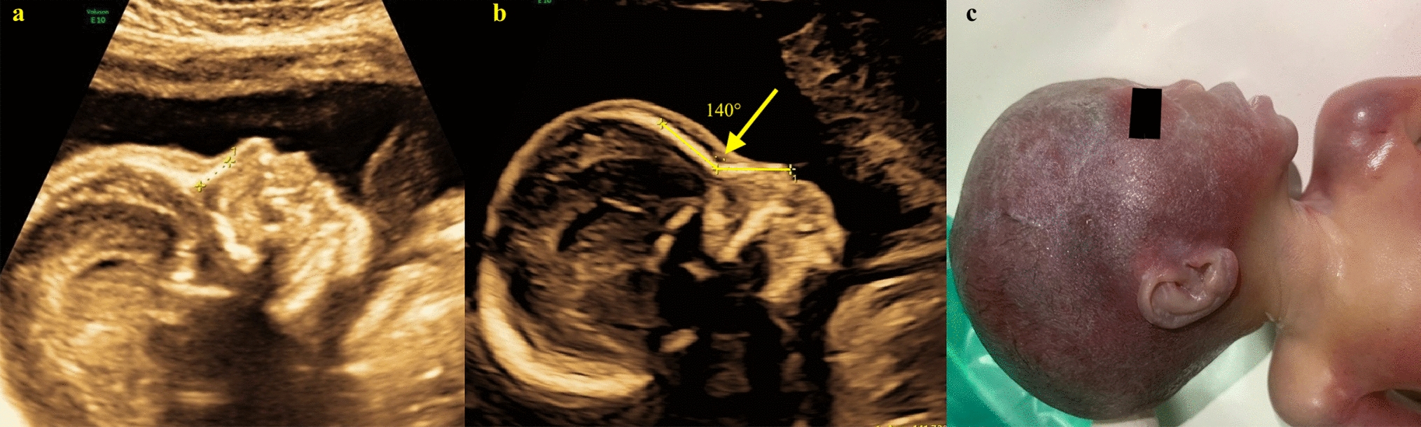 Fetal Flat-Facies on Prenatal Ultrasound: Is it Chondrodysplasia Punctata? A Retrospective Chart Review of 62 Fetuses
