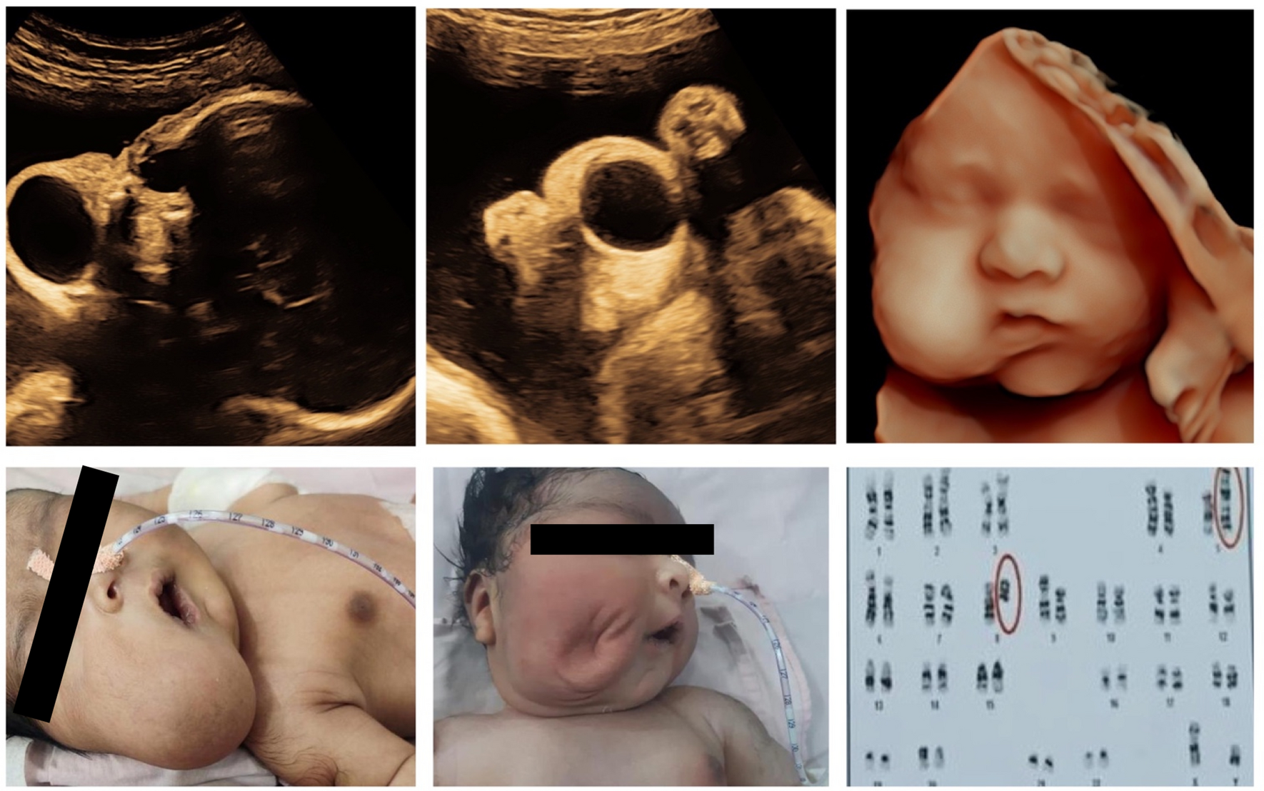 Prenatal 2-D and 3-D Ultrasound Characteristics of a Case of Fetal Orofacial Macrocystic Lymphatic Malformation and its Postnatal Management with Intralesional Bleomycin