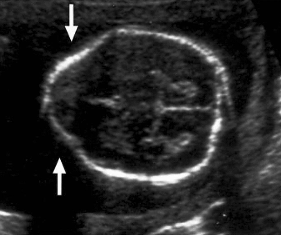 Maternal Levothyroxine Treatment as an Etiologic Factor in the Development of Infantile Craniosynostosis