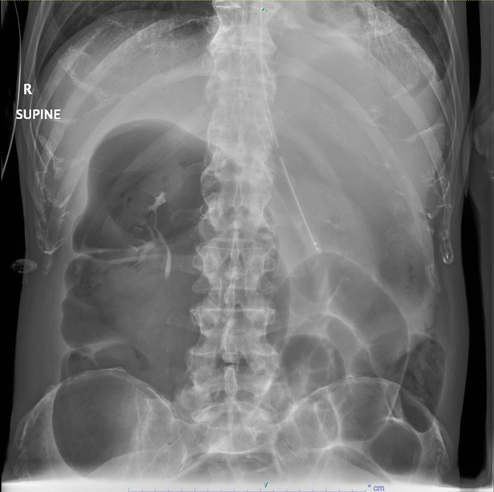 Cecal Volvulus Mimicking Small Bowel Obstruction—A Diagnostic Dilemma