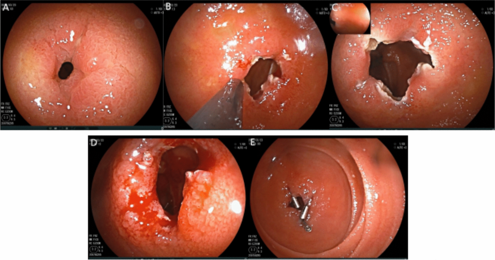 Endoscopic Treatment for Crohn’s Disease-Related Deep Small Intestinal Strictures: Balloon-Assisted Enteroscopy-Guided Stricturotomy Versus Balloon Dilation Therapy—A Single-Center Retrospective Study