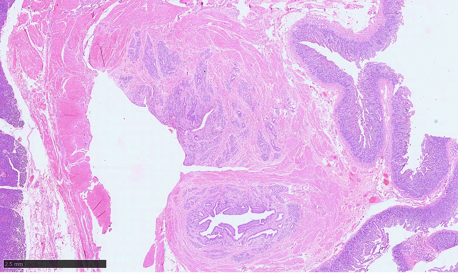 Adenomyomatous Hyperplasia of the Ampulla of Vater: Diagnostic Snapshot of a Benign Mimicker of Malignancy