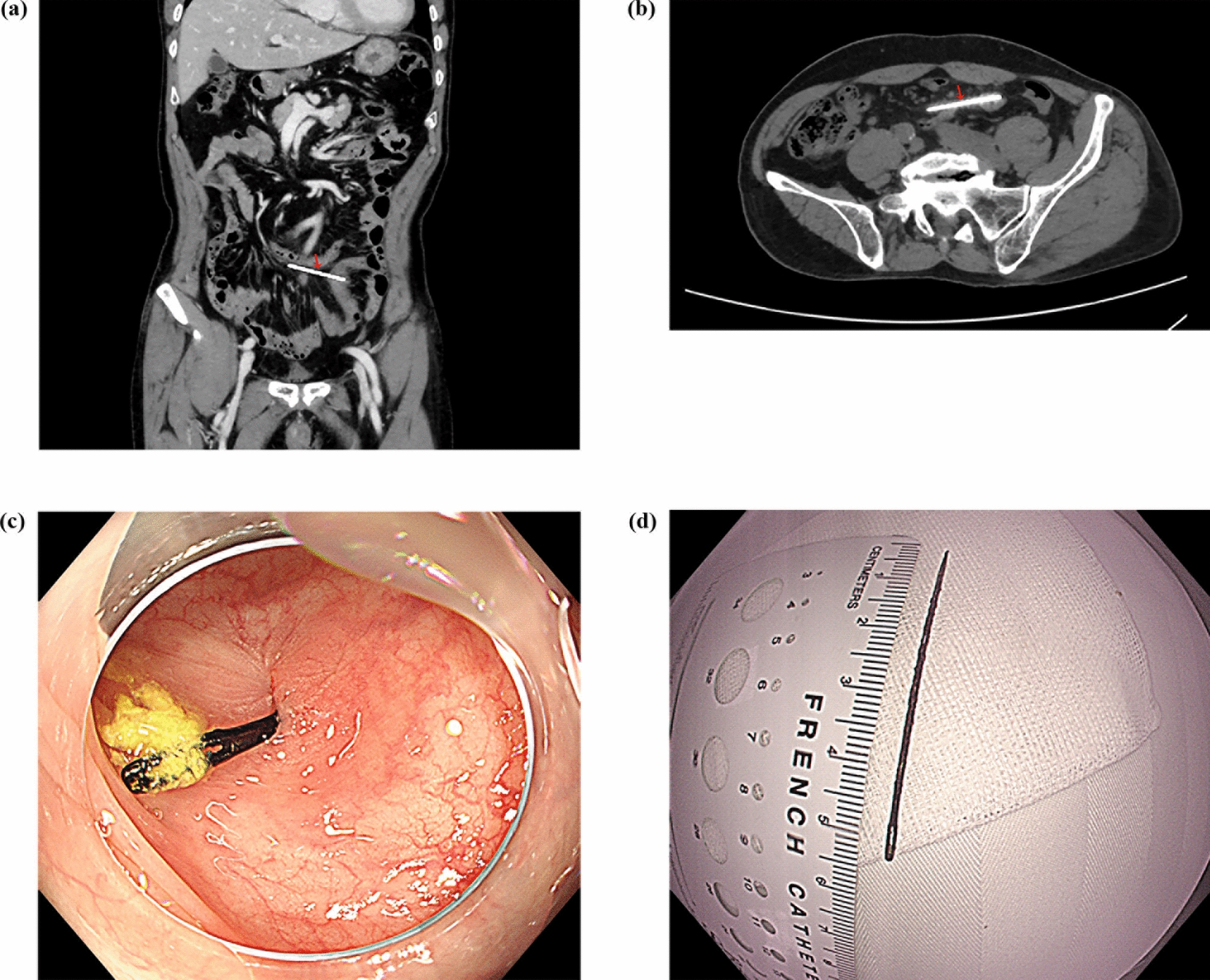 A Sewing Needle in the Sigmoid Colon