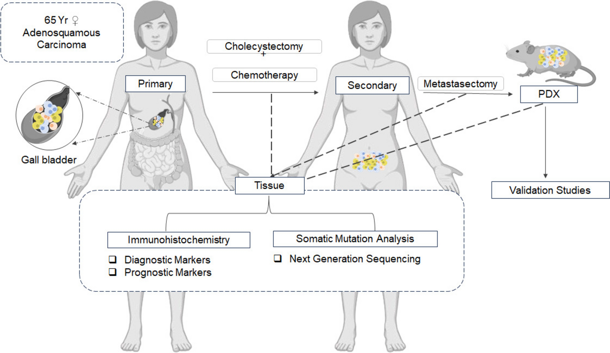 Deciphering Cancer Evolution Through Genomic Profiling of Patient-Derived Xenograft Together with Matched Primary Gallbladder Cancer