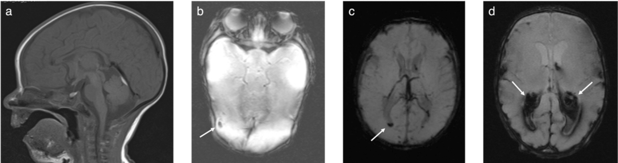 Neonatal hypoxic-ischaemic encephalopathy and therapeutic hypothermia: prognostic value of intra-axial haemorrhage