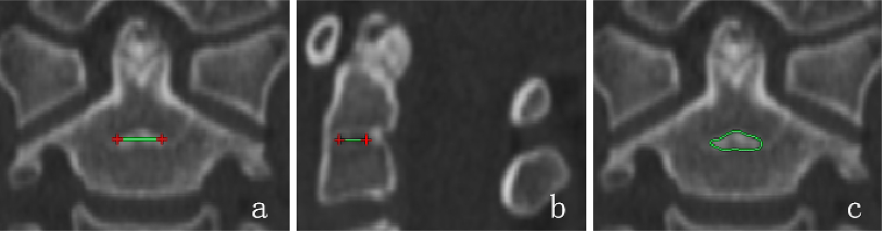 Imaging and histological study on the morphological development of the ossification center of the base of odontoid process in children