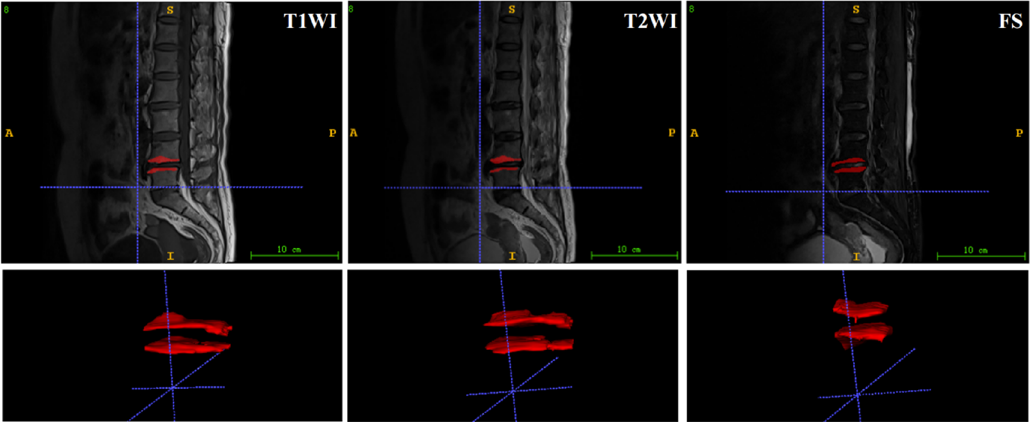 MRI radiomics reveals pain-related biomarkers for modic changes