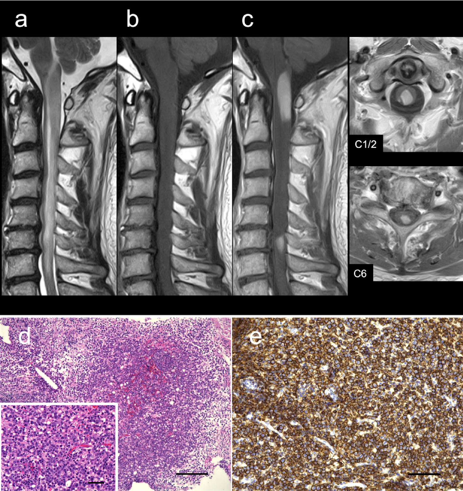 Primary spinal cord malignant B-cell lymphoma successfully treated with tirabrutinib at relapse: a case report