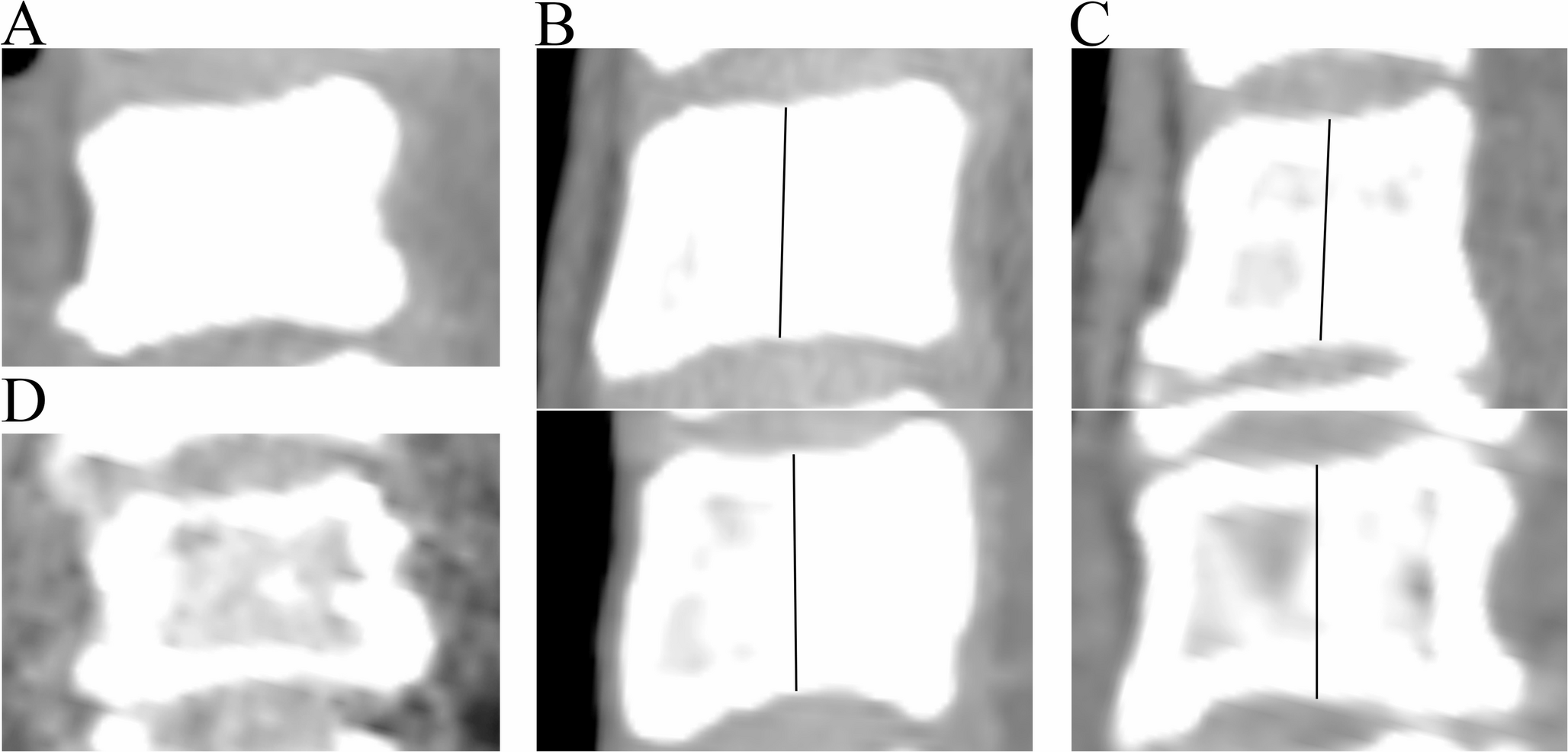 A novel CT soft tissue window-based visual scoring system for rapid assessment of bone density
