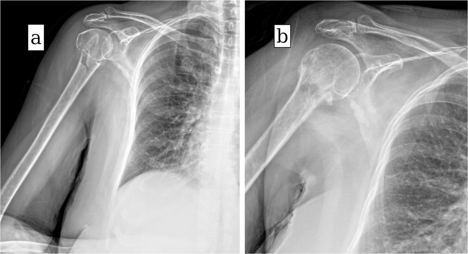 Osteoporotic Fractures of the Proximal Humerus: an In-Depth Review of Current Management Options