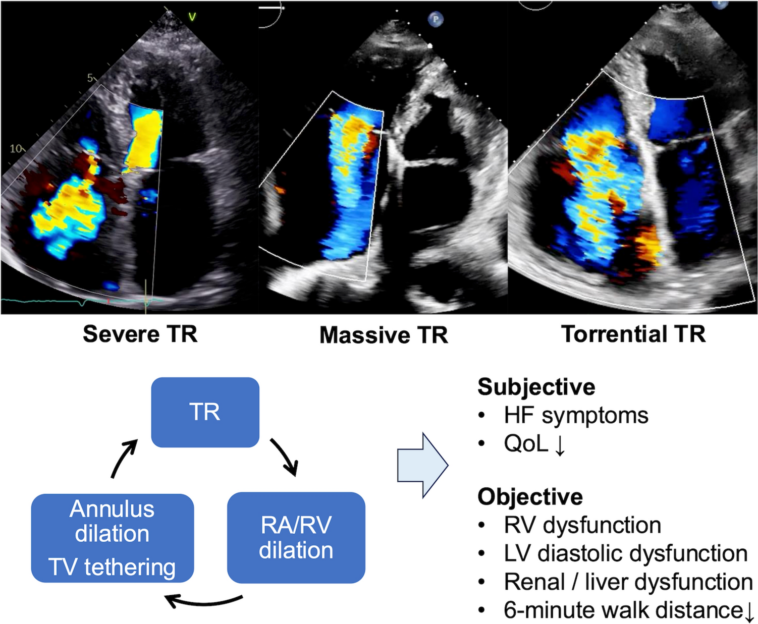 Indication and timing in tricuspid interventions