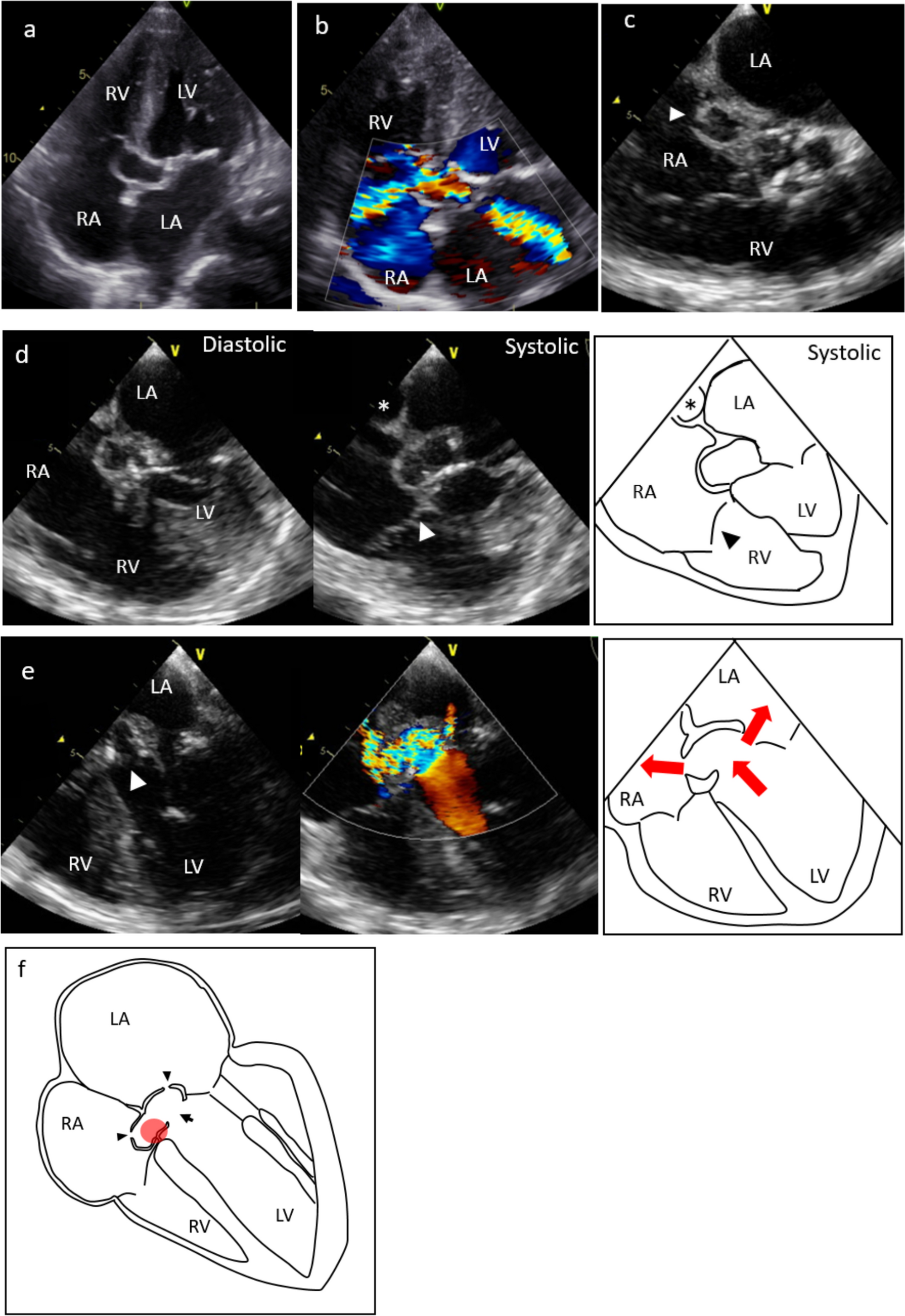 Gerbode defect concomitant with LV–LA shunt and complete atrioventricular block due to infective endocarditis