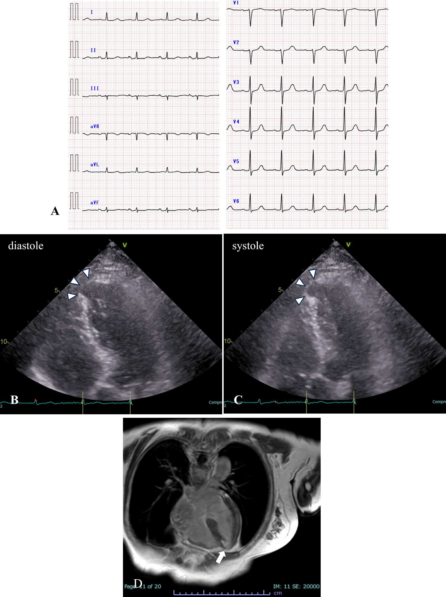 A case of possible MINOCA detected through echocardiography