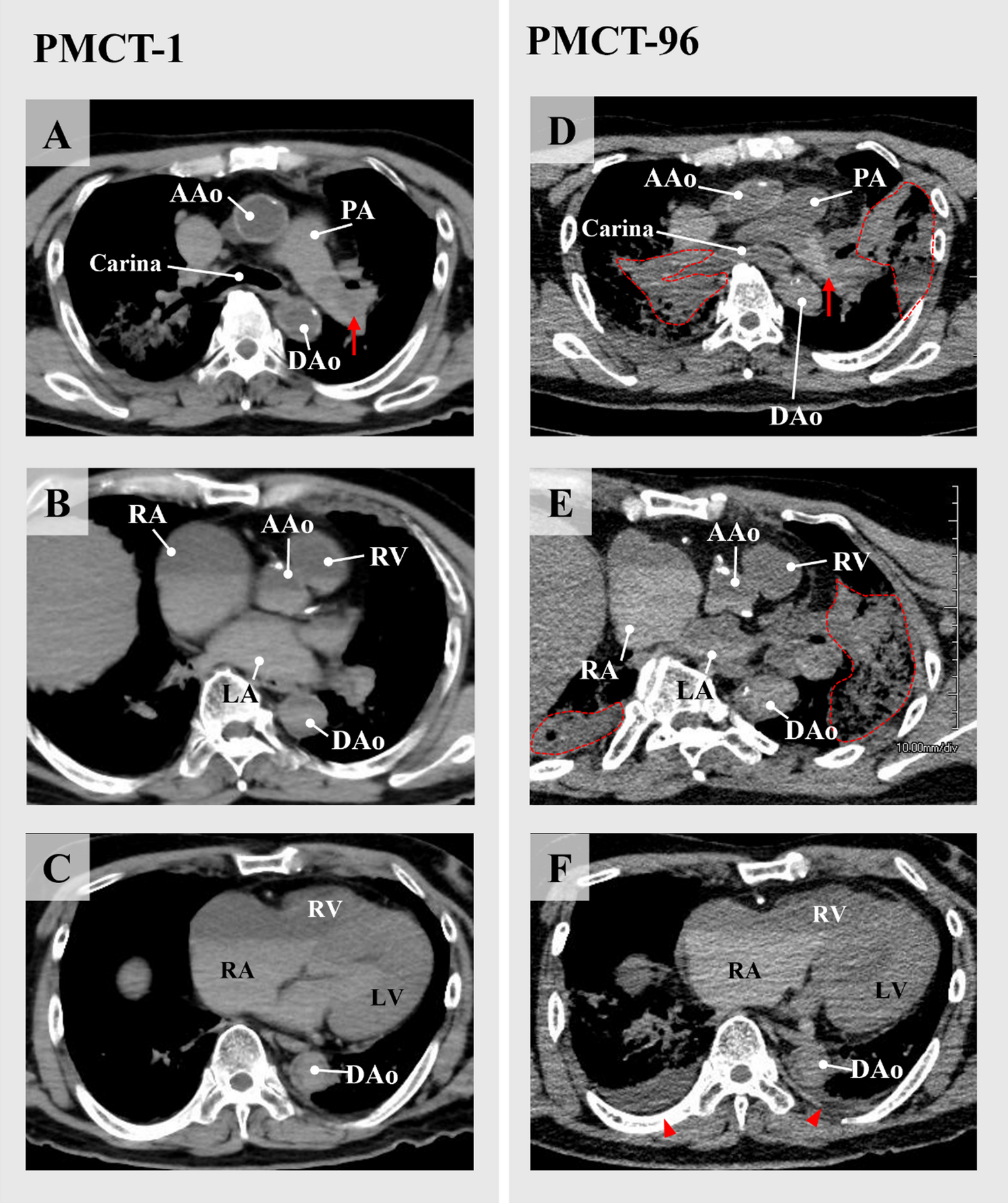 Imaging changes of pulmonary thromboembolism on postmortem computed tomography