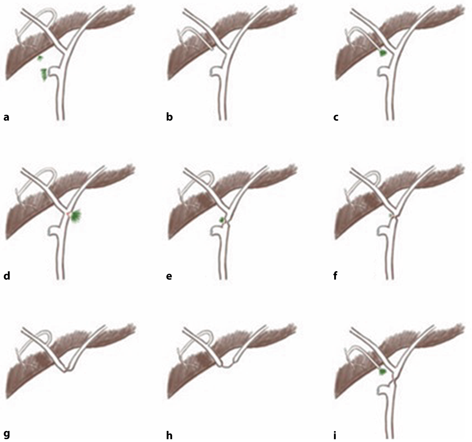Management of major complications after hepatectomy﻿