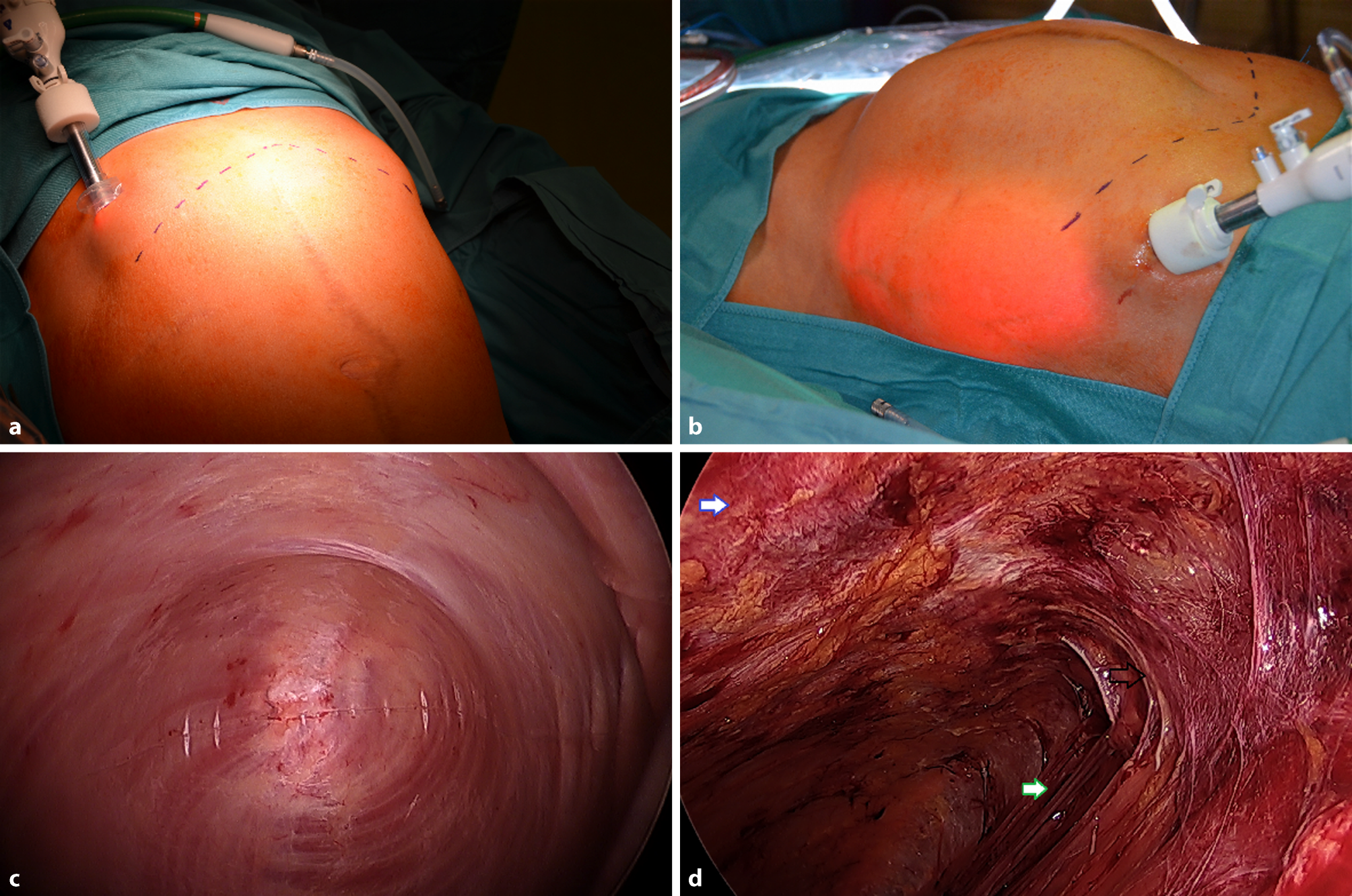 Endoscopic anterior component separation—technical report