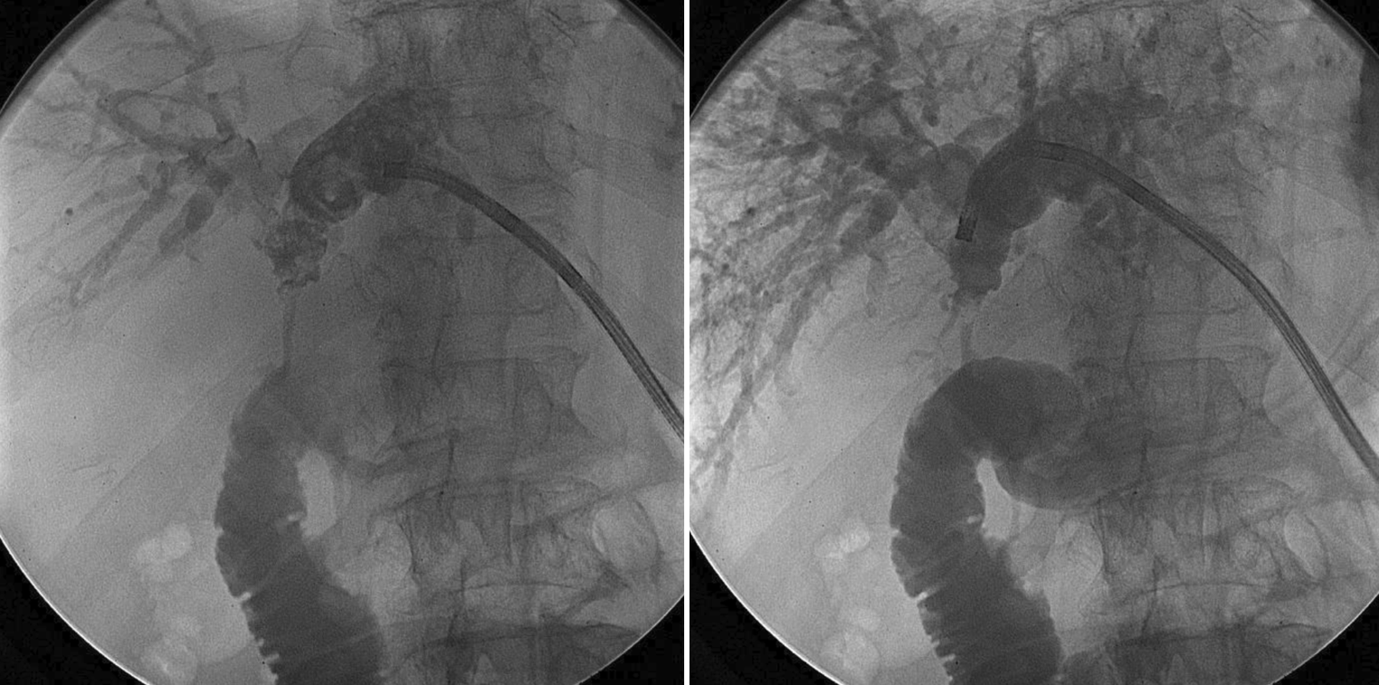 Percutaneous transhepatic cholangioscopy and lithotripsy using a single-operator cholangioscope for the management of biliary stones in postoperative anatomical variations