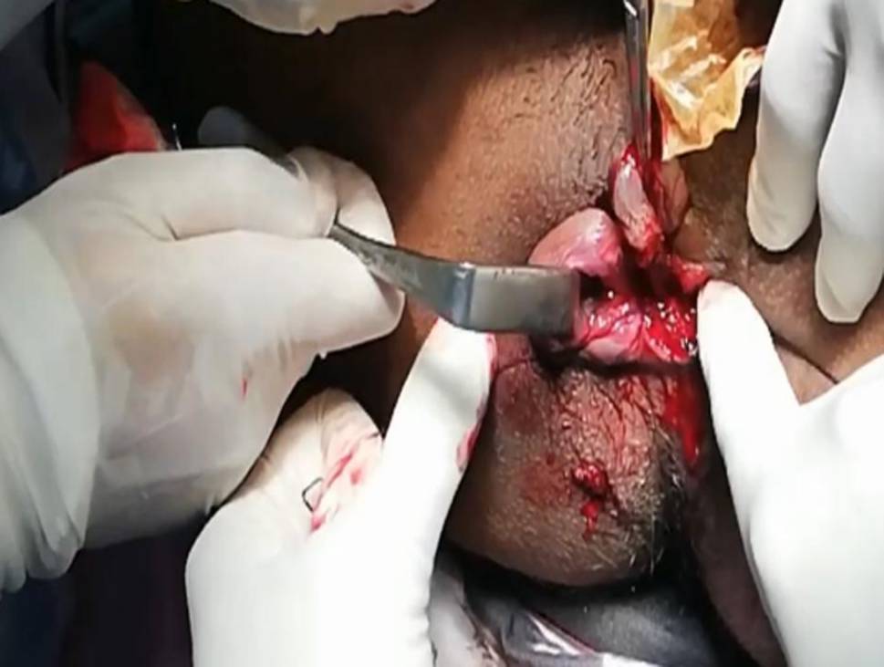 Stapled hemorrhoidopexy vs. open (Milligan–Morgan) hemorrhoidectomy—a comparative analysis
