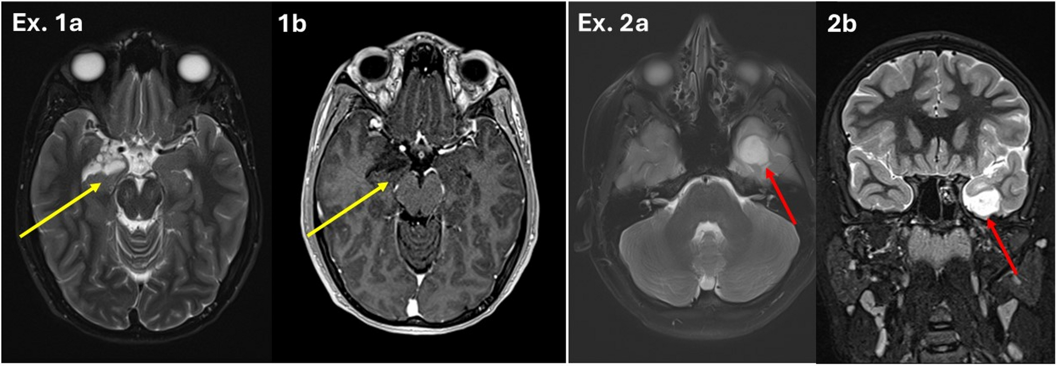 Treatment Considerations in Tumor-Related Epilepsy