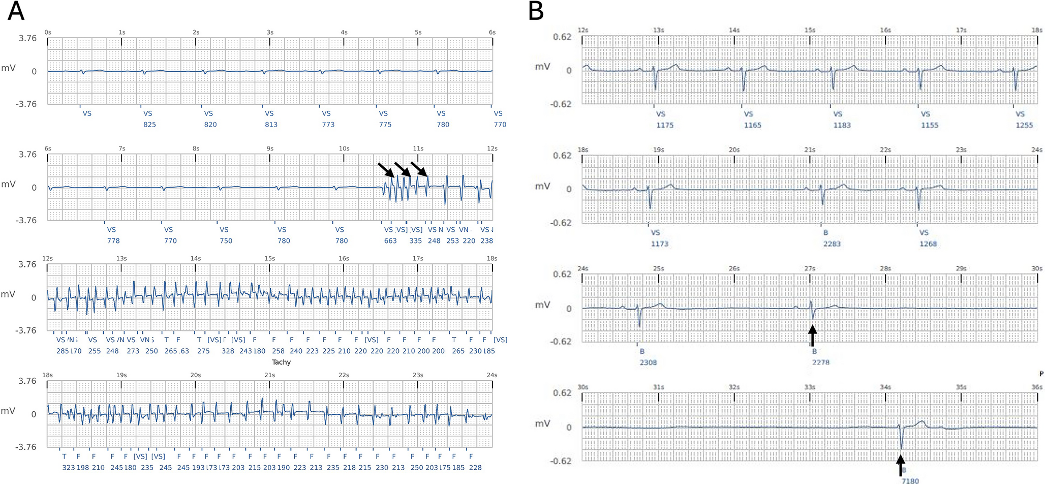 Treatment of Epilepsy in Patients with Cardiovascular Disease