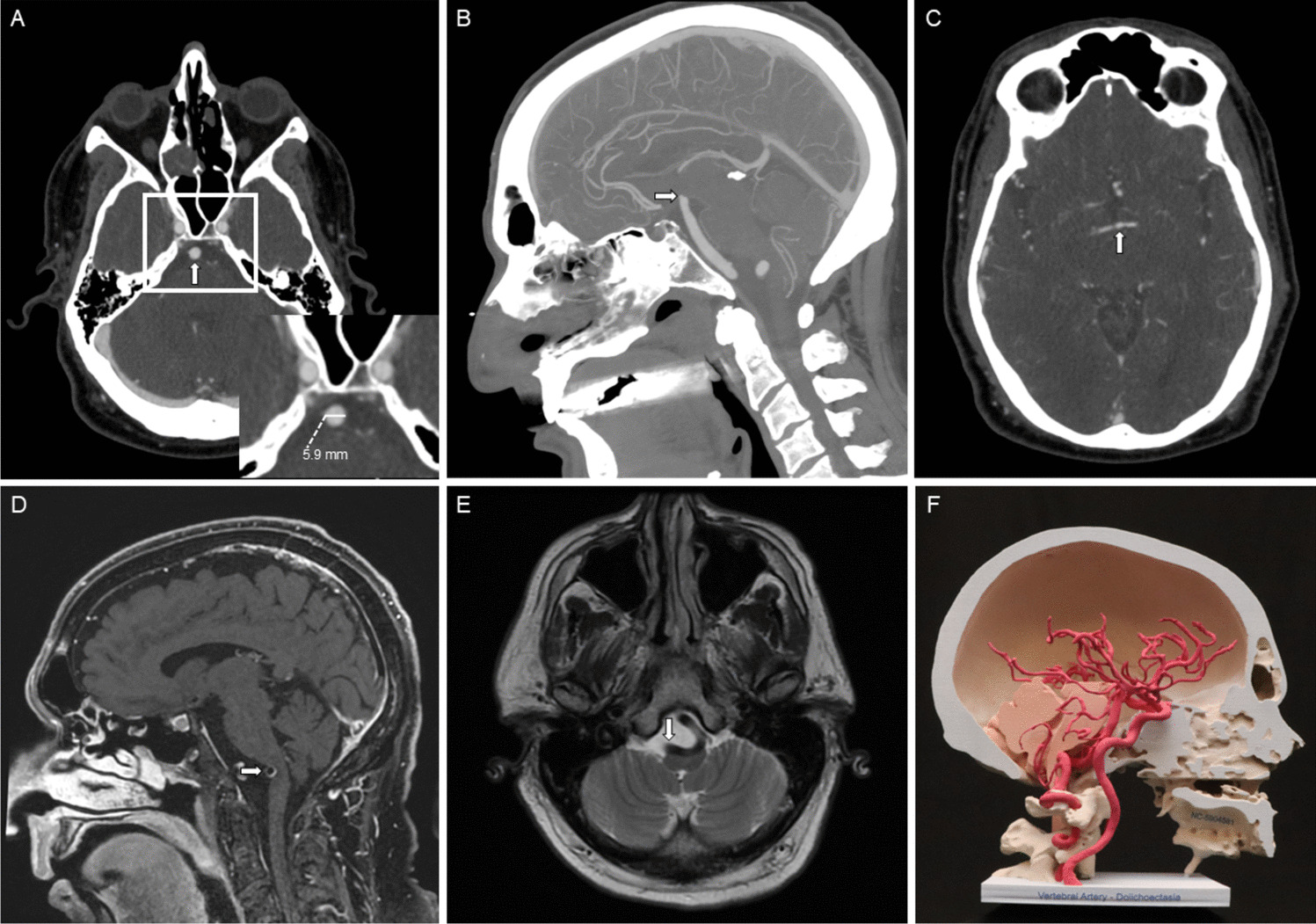 Update on Management in Patients with Vertebrobasilar Dolichoectasia