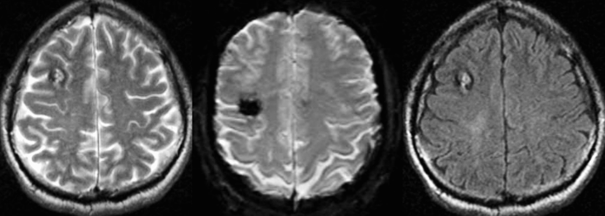 A Review of Current Advances in the Treatment of Cerebral Cavernous Malformations