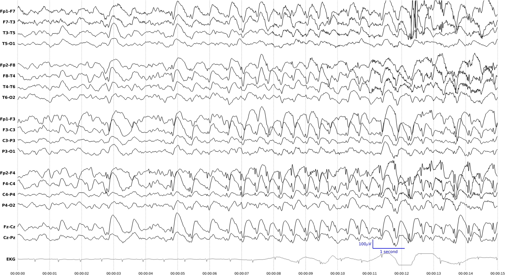 Continuous EEG in Day to Day Neurocritical Care – A Case Based Review