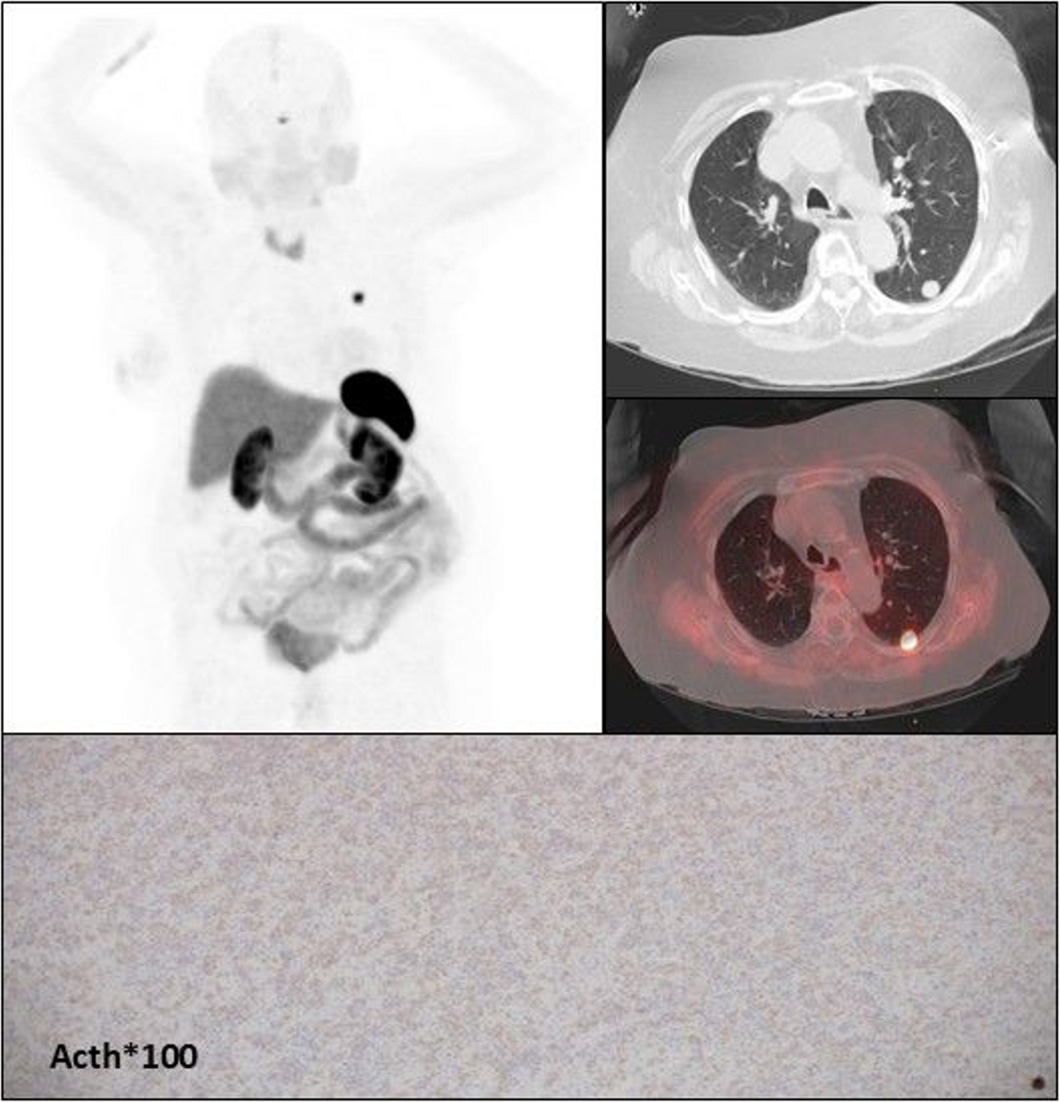 Update in the Management of ACTH-Secreting Gastroenteropancreatic and Thoracic Neuroendocrine Neoplasms
