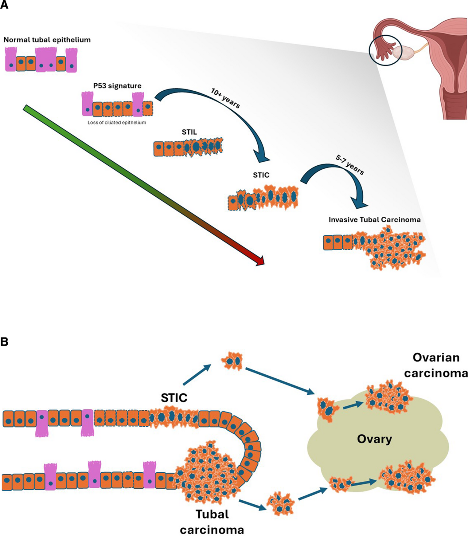 From Fallopian Tube to Ovarian Cancer: Understanding the Evaluation and Management of Serous Tubal Intraepithelial Carcinoma Lesions