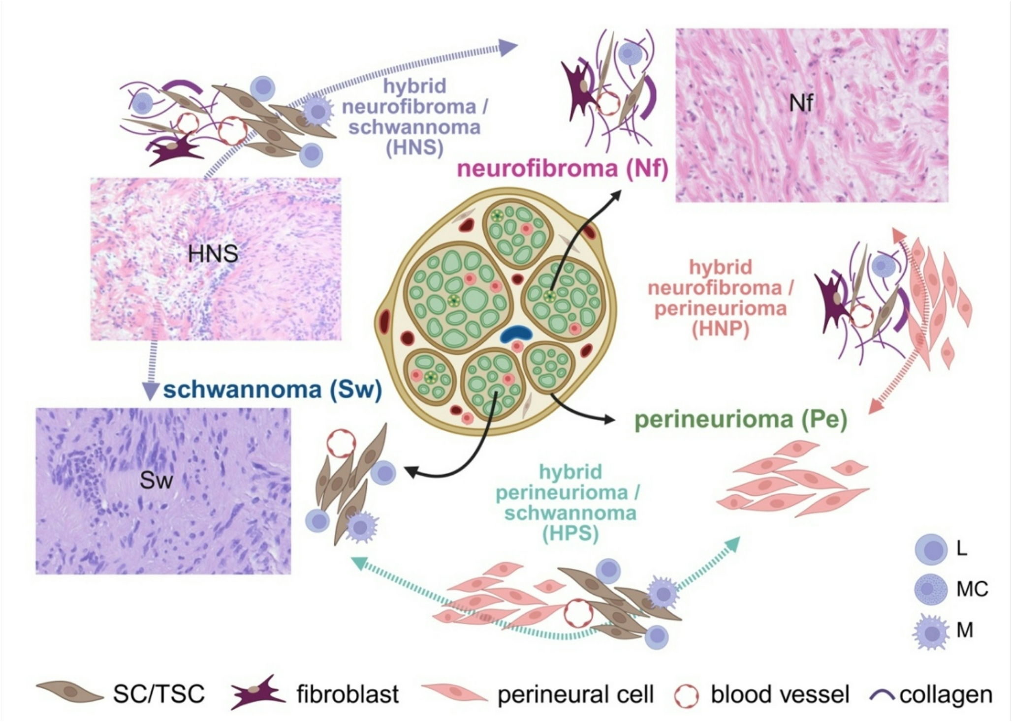 Hybrid neurofibroma/schwannoma in schwannomatosis—a diagnostically challenging benign peripheral nerve sheath tumour