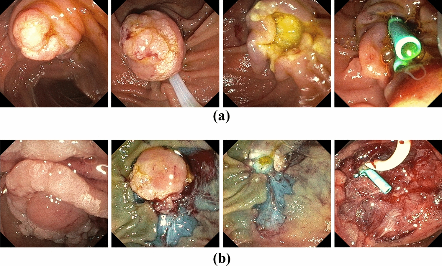 Endoscopic papillectomy for ampullary adenomas in familial adenomatous polyposis