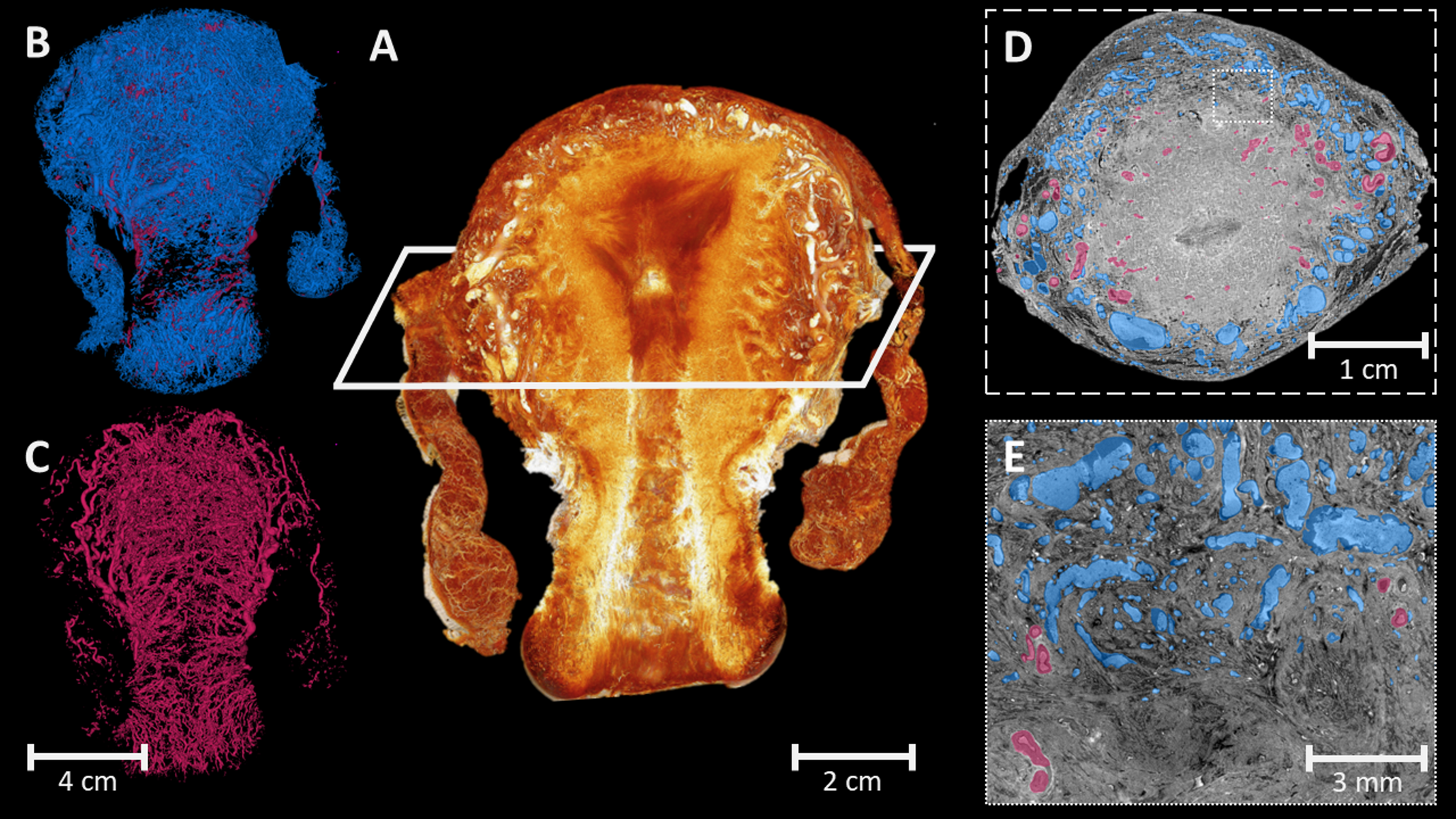Revealing the unseen: 3D synchrotron X-Ray imaging of uterine vasculature in adenomyosis
