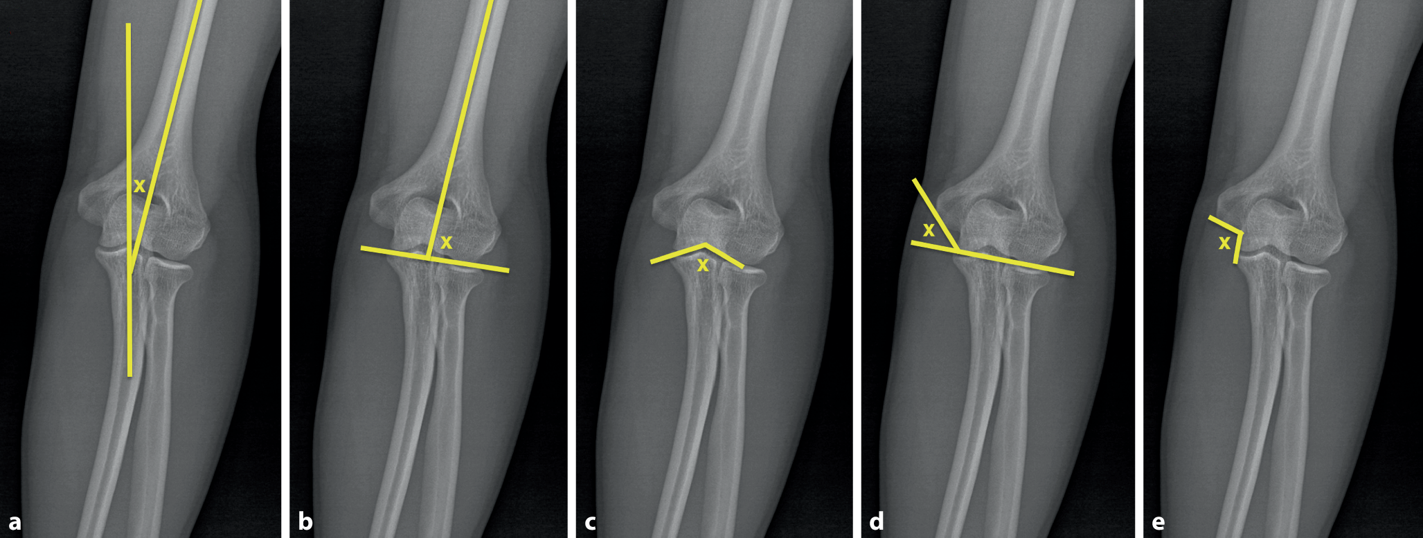 Carrying angle and medial epicondyle inclination angle as predictive factors for cubital tunnel syndrome