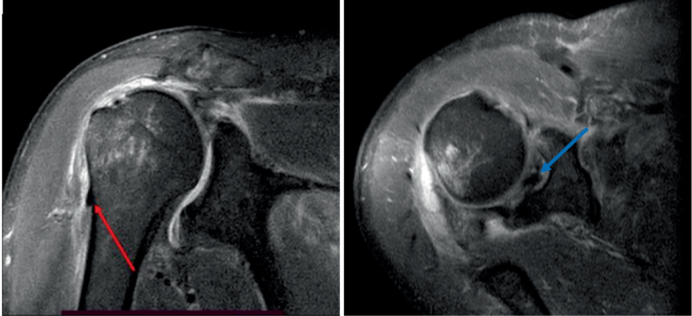 A rare shoulder injury: massive rotator cuff tear with posterior dislocation of long head of the biceps tendon