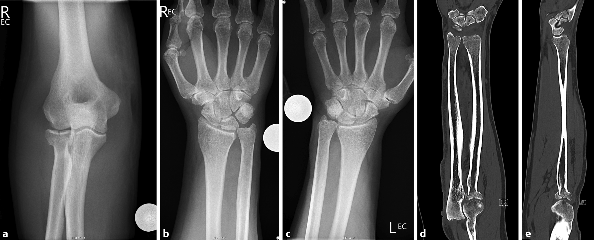 Missed Essex–Lopresti lesion in the presence of bilateral positive ulnar variance