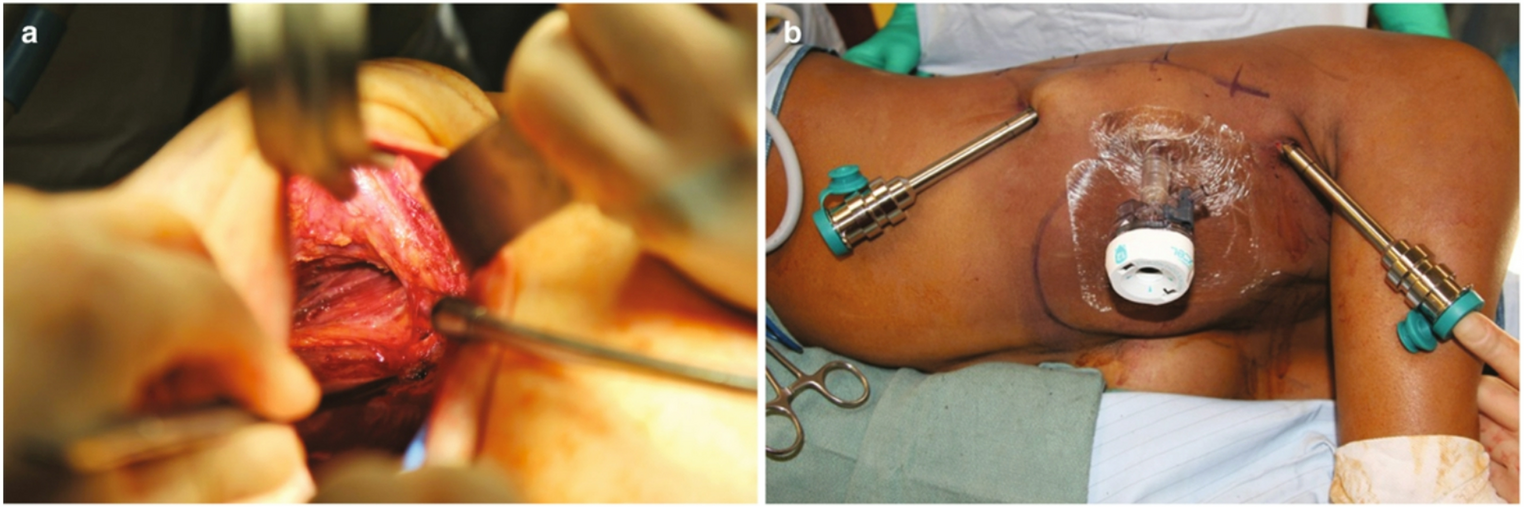 Optimizing Breast Reconstruction: Nerve Preservation in Nipple-Sparing Mastectomy, Immediate and Delayed Implant-Based Reconstruction, Complex Closures, Acellular Dermal Matrix versus GalaFLEX, and Negative Pressure Wound Therapy