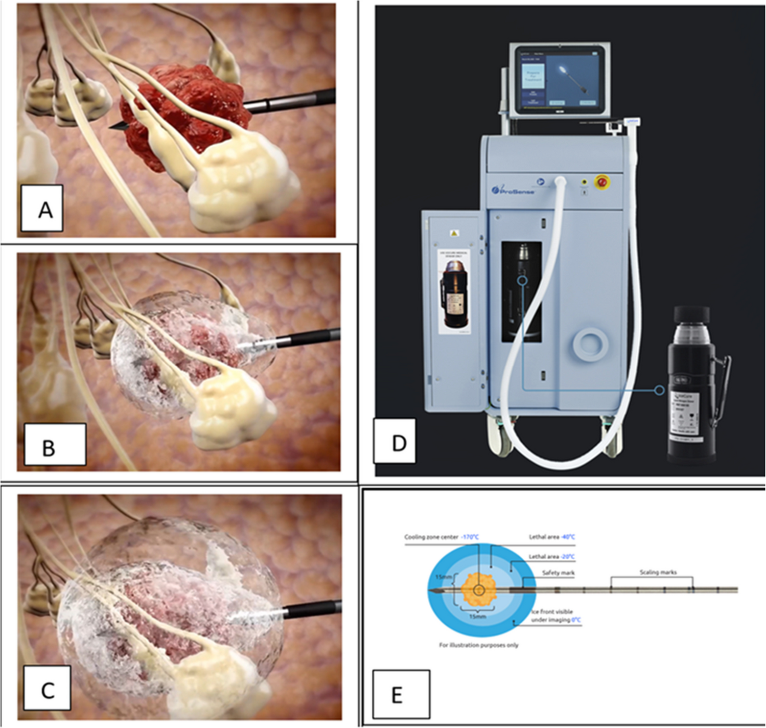 Ablative Therapies for Early-Stage Breast Cancer